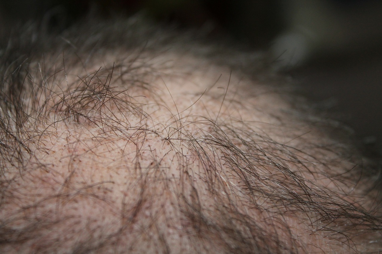 Haarausfall bei Männern - Ursachen und Lösungen